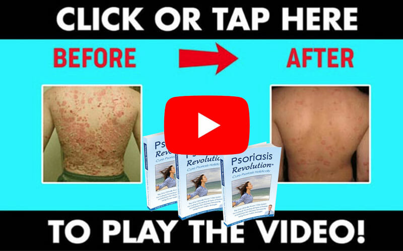 Psoriasis Revolution Clickable Image