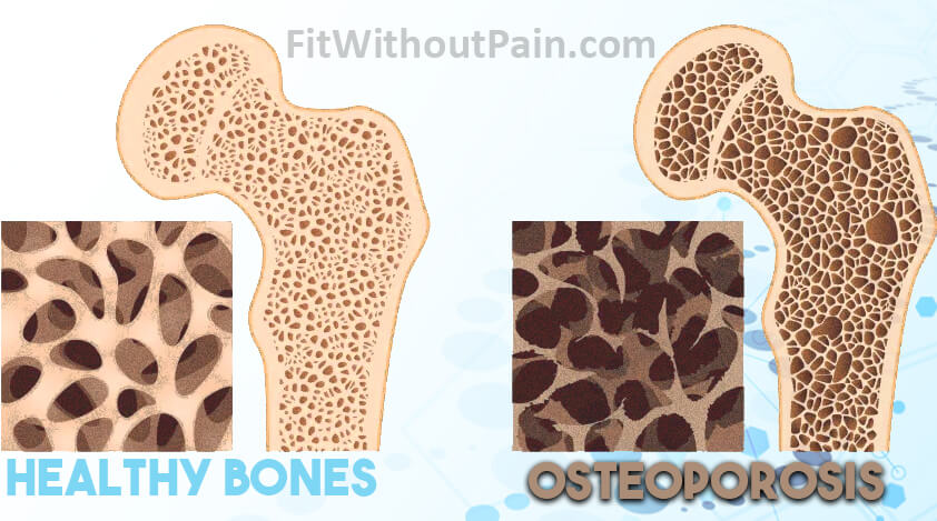 The Bone Density Solution Healthy Bones