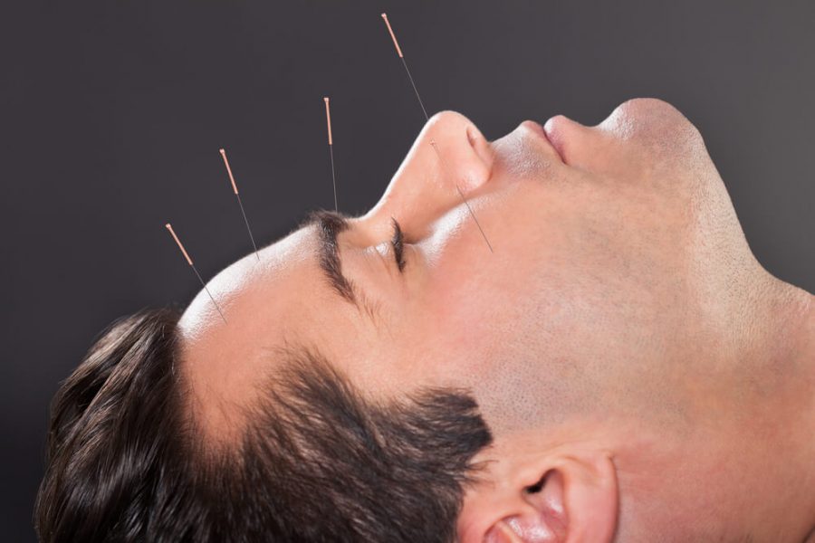 Acupuncture Treatment