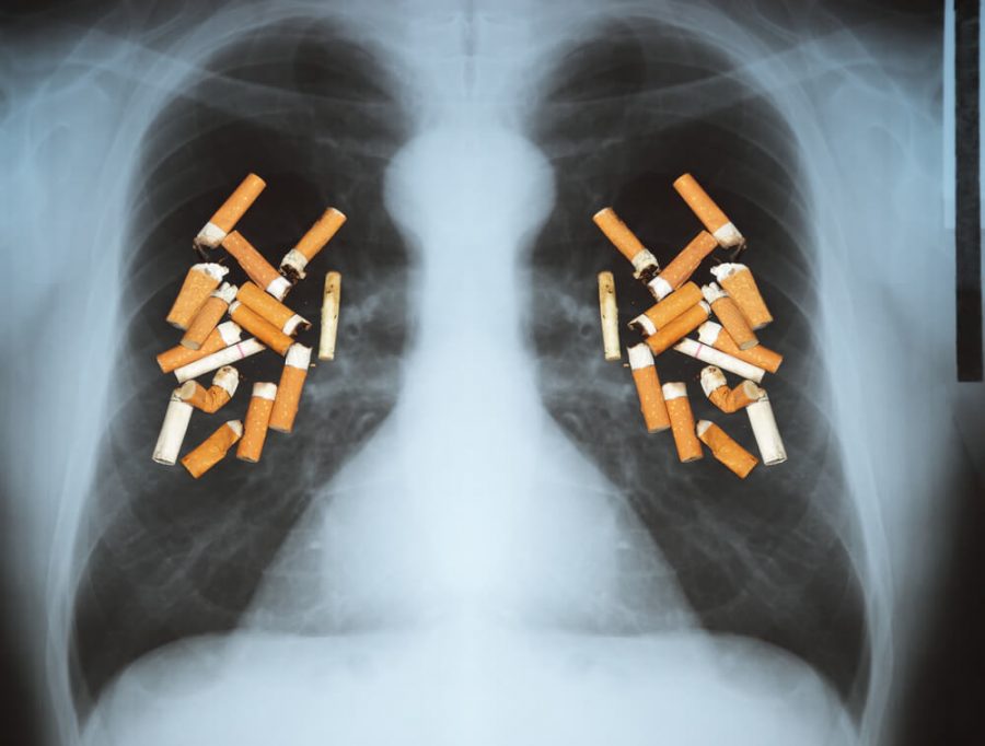 Effects of cigarette smoking - lung cancer.