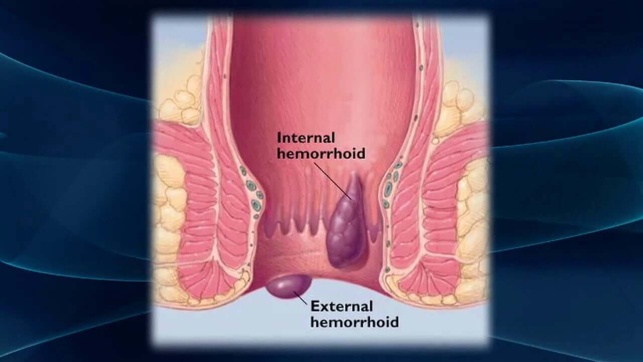 What are Hemorrhoids