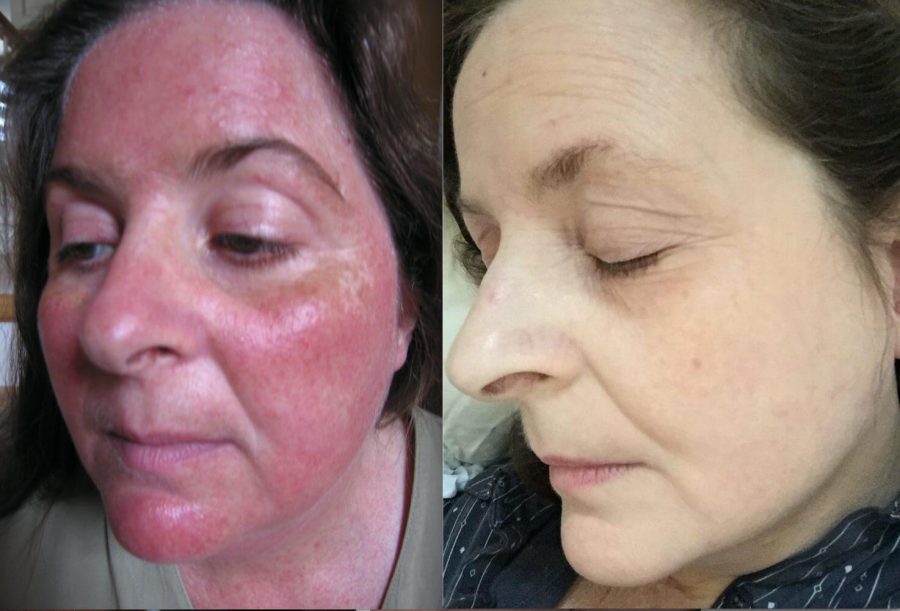 Rosacea Free Forever