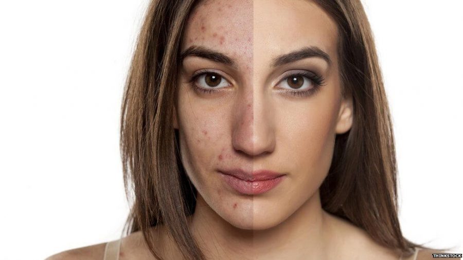 before and after with acne