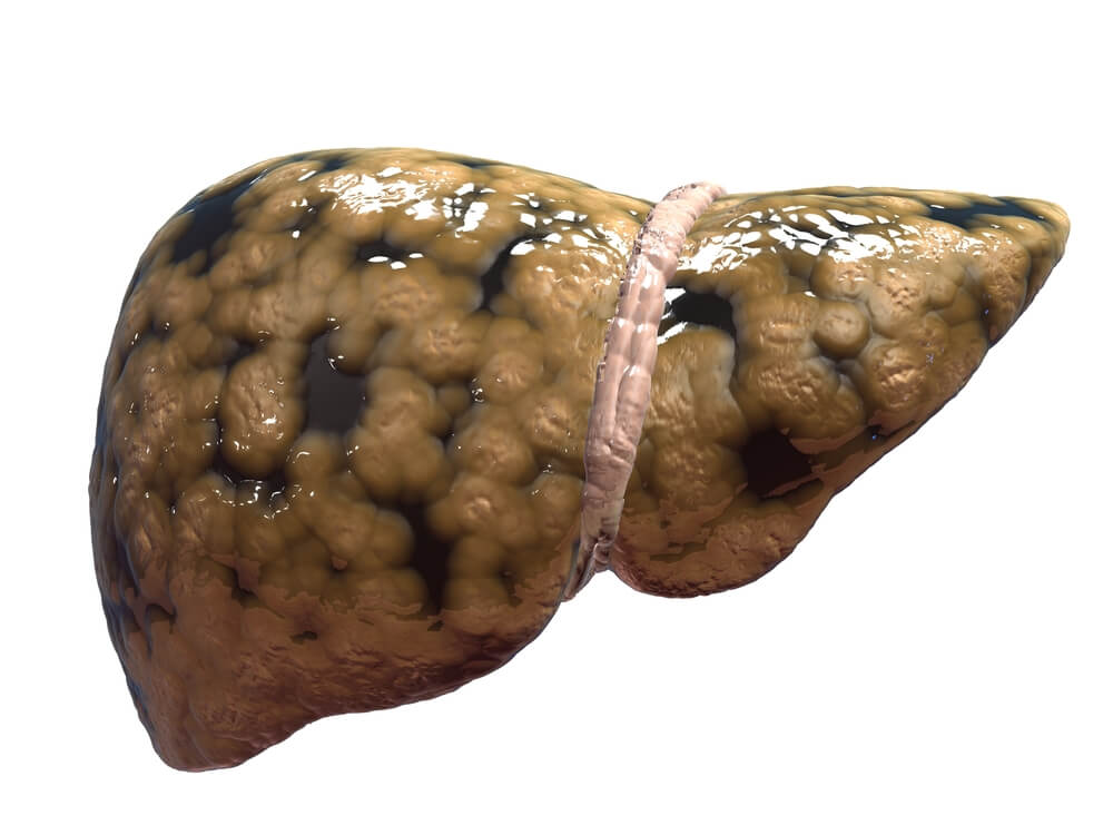 fatty liver