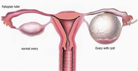 An ovarian cyst!